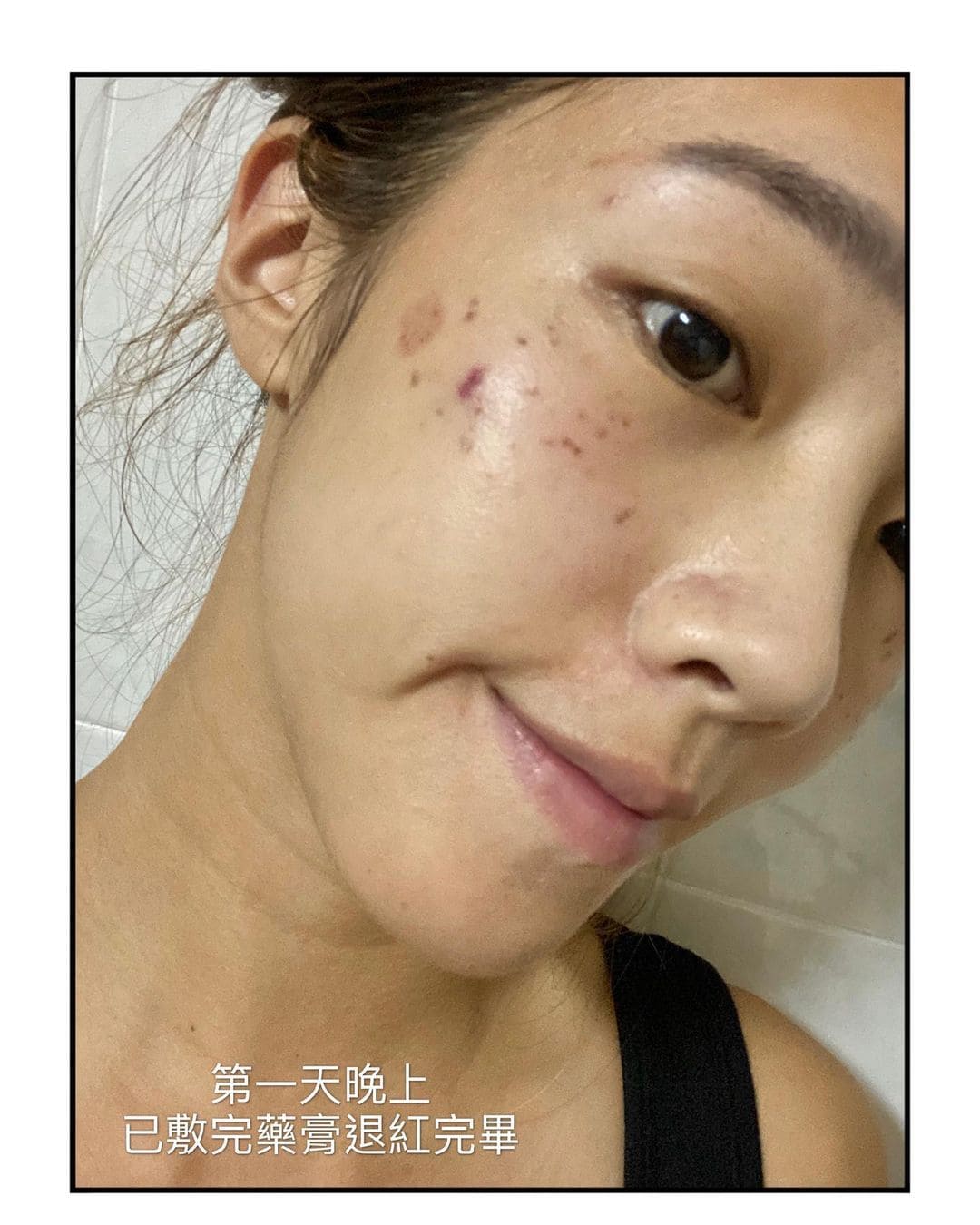 【皮秒雷射】星采整形外科診所(大安)-皮秒改善惱人的曬斑~-Clara克啦啦
